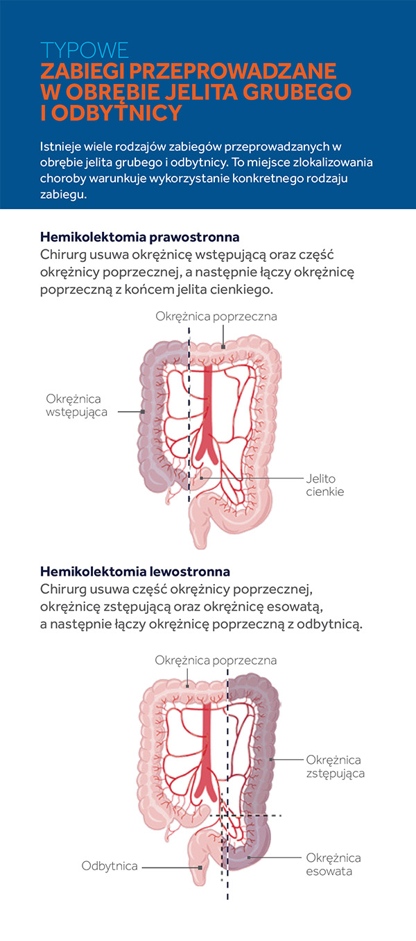 lapco-rak-jelita-grubego-02